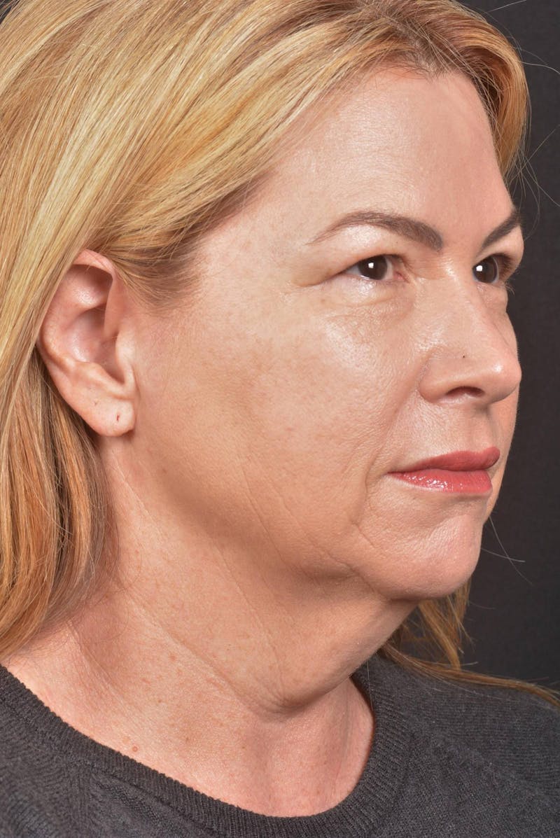 Facelift Before & After Gallery - Patient 827365 - Image 9