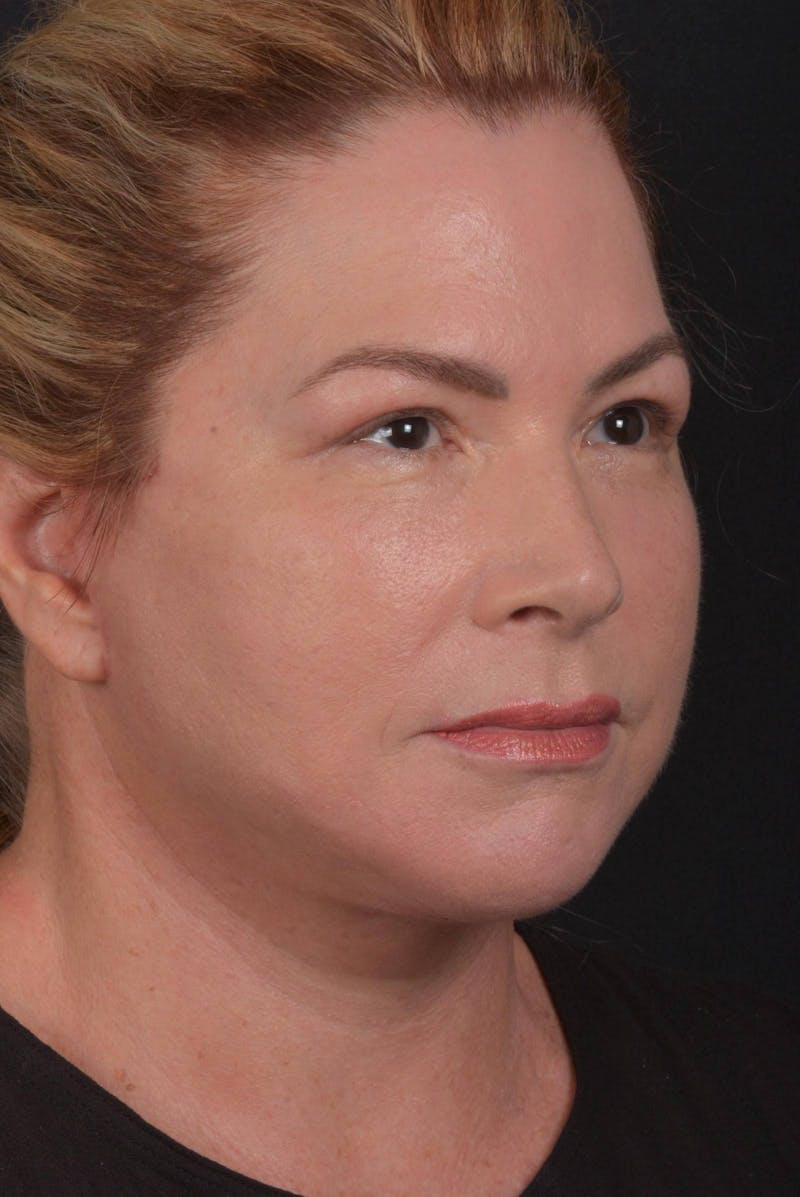 Facelift Before & After Gallery - Patient 827365 - Image 10