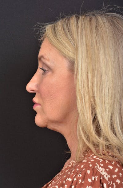 Facelift Before & After Gallery - Patient 276162 - Image 1