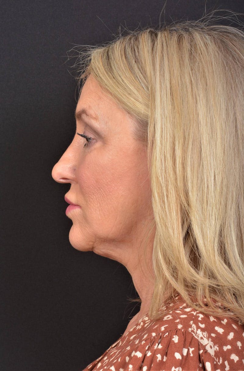 Facelift Before & After Gallery - Patient 276162 - Image 1