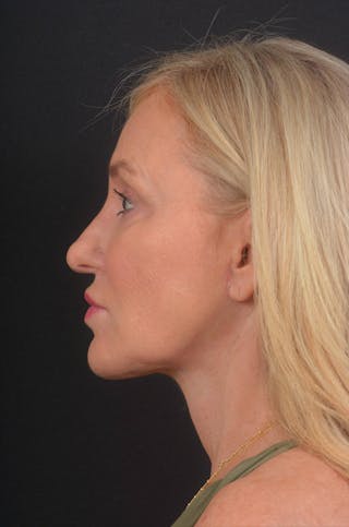Facelift Before & After Gallery - Patient 276162 - Image 2