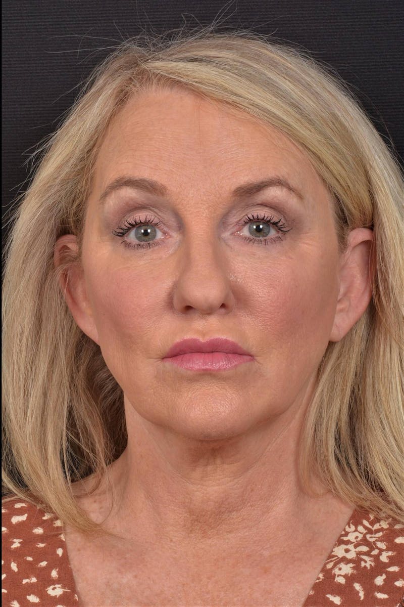 Facelift Before & After Gallery - Patient 276162 - Image 3