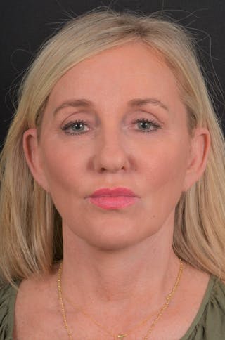 Facelift Before & After Gallery - Patient 276162 - Image 4