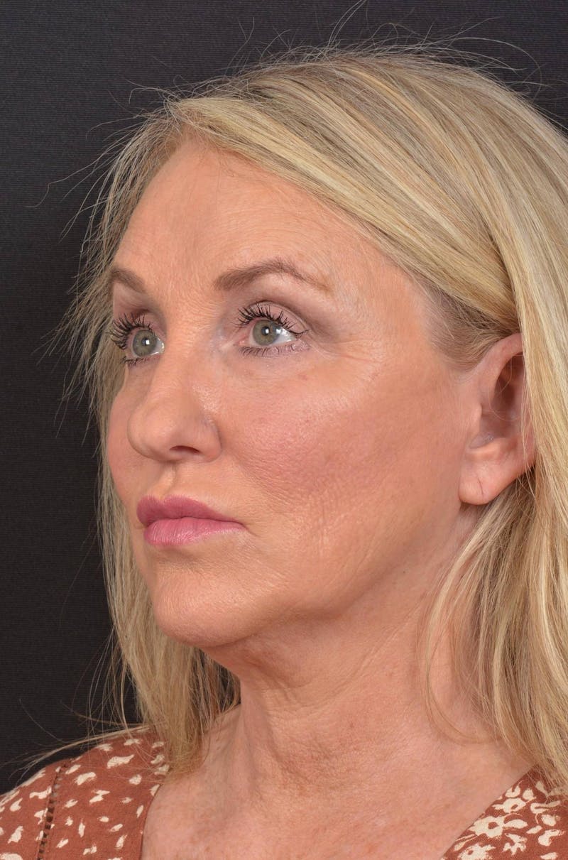 Facelift Before & After Gallery - Patient 276162 - Image 5