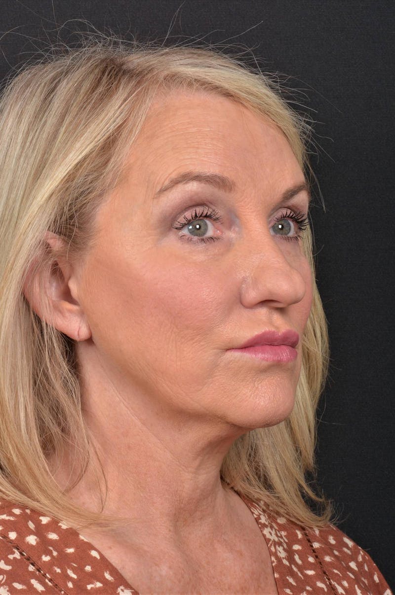 Facelift Before & After Gallery - Patient 276162 - Image 7