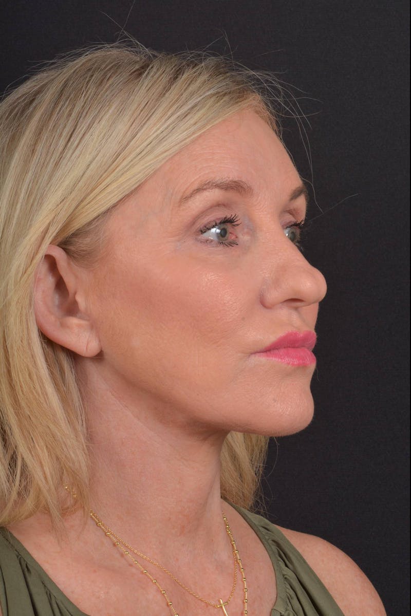 Facelift Before & After Gallery - Patient 276162 - Image 8