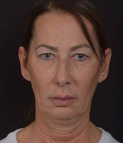 Facelift Before & After Gallery - Patient 346802 - Image 1