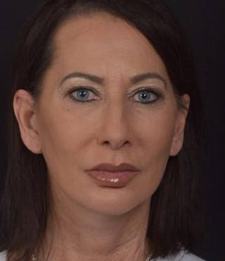 Facelift Before & After Gallery - Patient 346802 - Image 2
