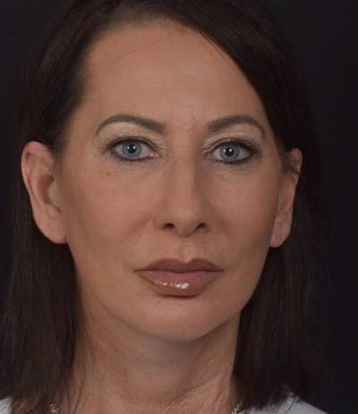 Facelift Before & After Gallery - Patient 346802 - Image 2