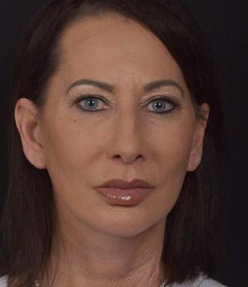 Facelift Before & After Gallery - Patient 346802 - Image 2