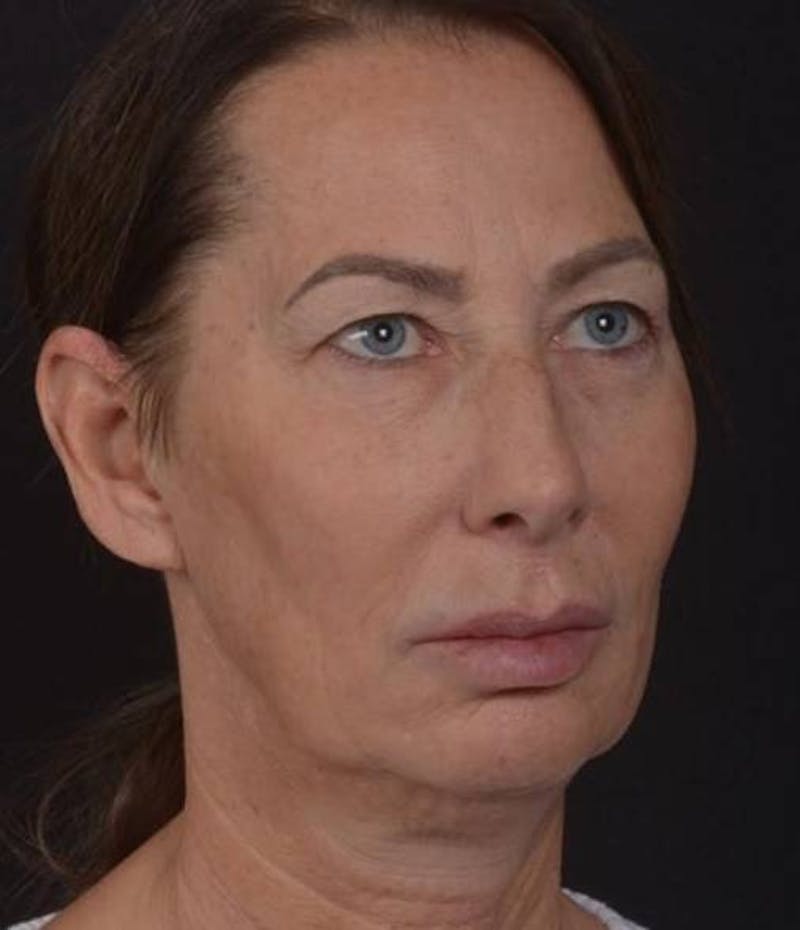 Facelift Before & After Gallery - Patient 346802 - Image 9