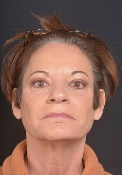 Facelift Before & After Gallery - Patient 466246 - Image 1
