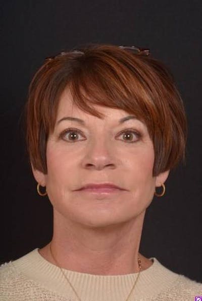 Facelift Before & After Gallery - Patient 466246 - Image 2