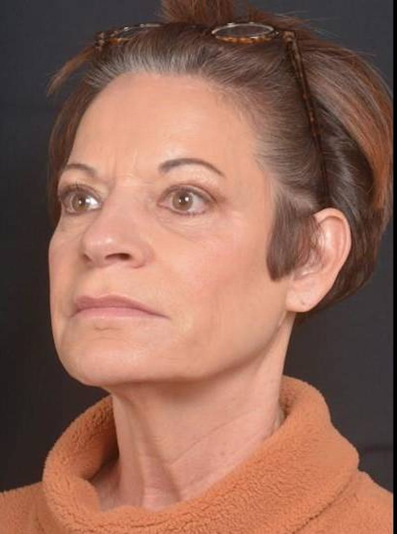 Facelift Before & After Gallery - Patient 466246 - Image 3