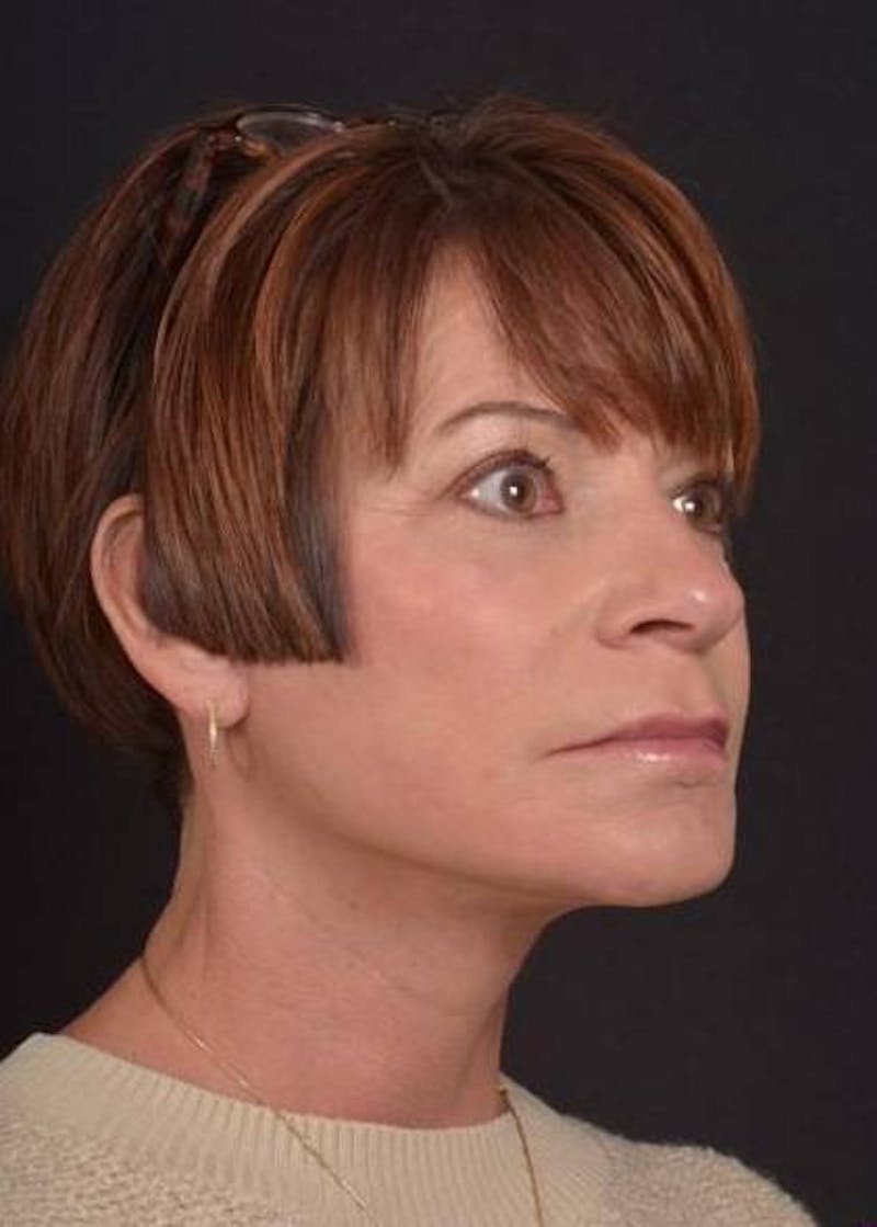 Facelift Before & After Gallery - Patient 466246 - Image 6