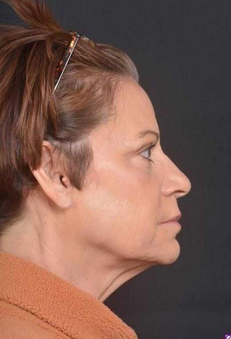 Facelift Before & After Gallery - Patient 466246 - Image 9