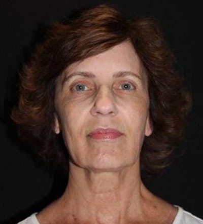 Facelift Before & After Gallery - Patient 191773 - Image 1