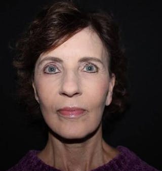 Facelift Before & After Gallery - Patient 191773 - Image 2
