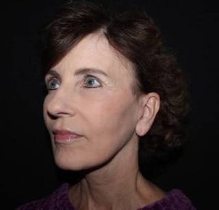 Facelift Before & After Gallery - Patient 191773 - Image 4