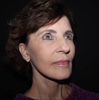 Facelift Before & After Gallery - Patient 191773 - Image 8