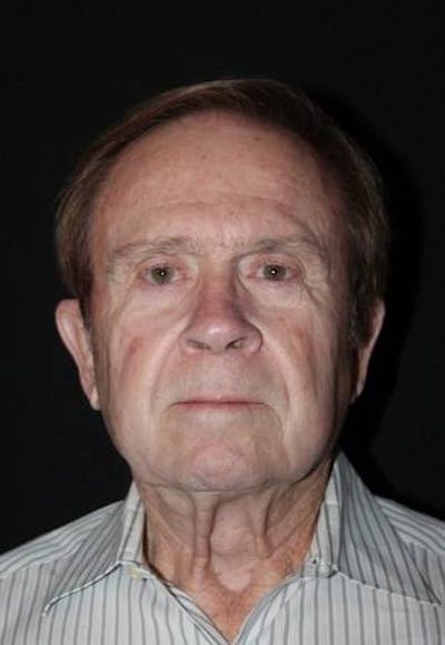 Facelift Before & After Gallery - Patient 295117 - Image 1