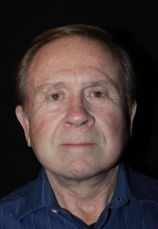 Facelift Before & After Gallery - Patient 295117 - Image 2