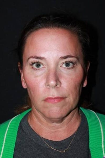 Facelift Before & After Gallery - Patient 391777 - Image 1