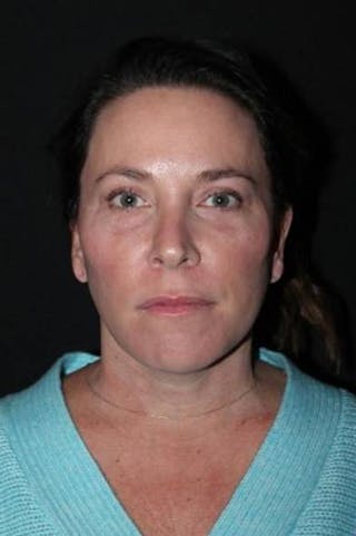 Facelift Before & After Gallery - Patient 391777 - Image 2