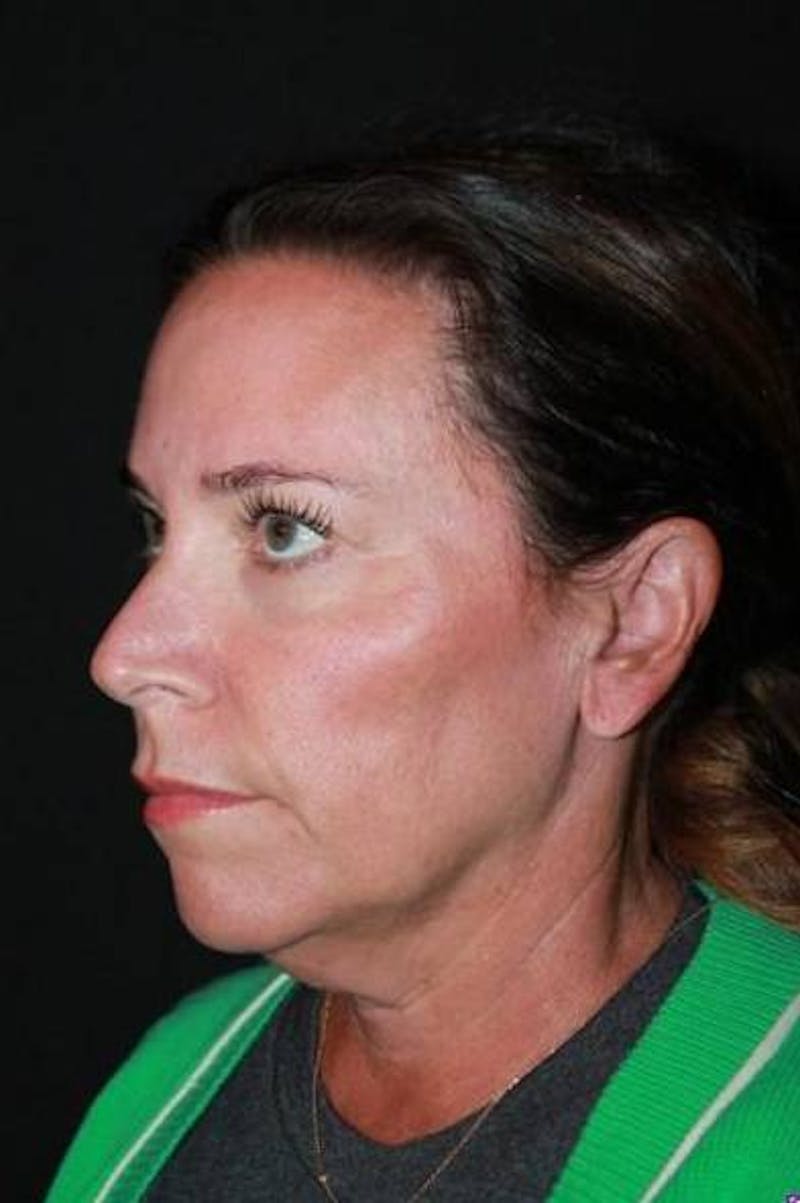 Facelift Before & After Gallery - Patient 391777 - Image 3