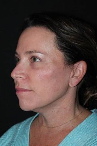 Facelift Before & After Gallery - Patient 391777 - Image 4