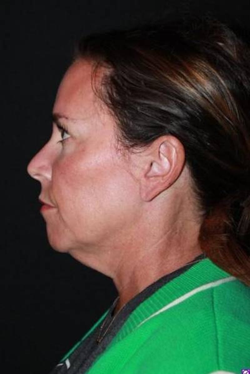 Facelift Before & After Gallery - Patient 391777 - Image 5