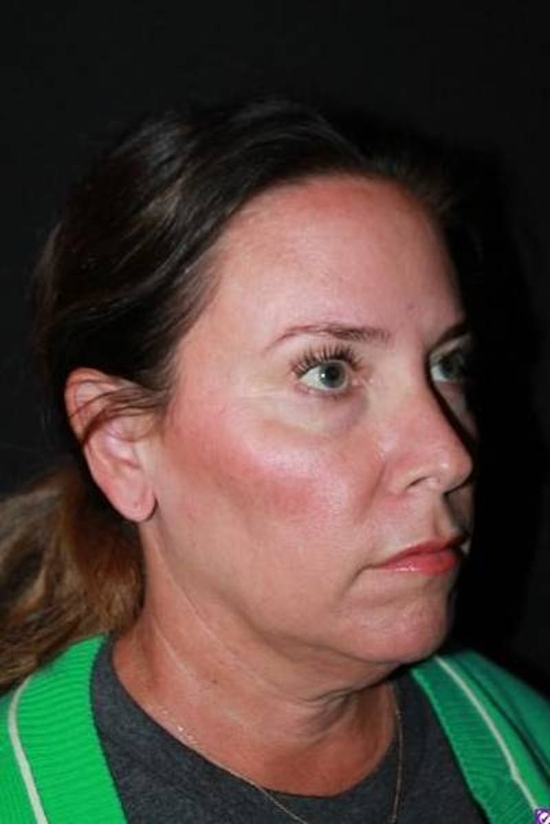 Facelift Before & After Gallery - Patient 391777 - Image 7