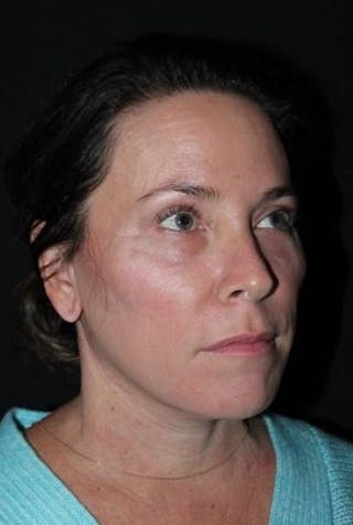 Facelift Before & After Gallery - Patient 391777 - Image 8