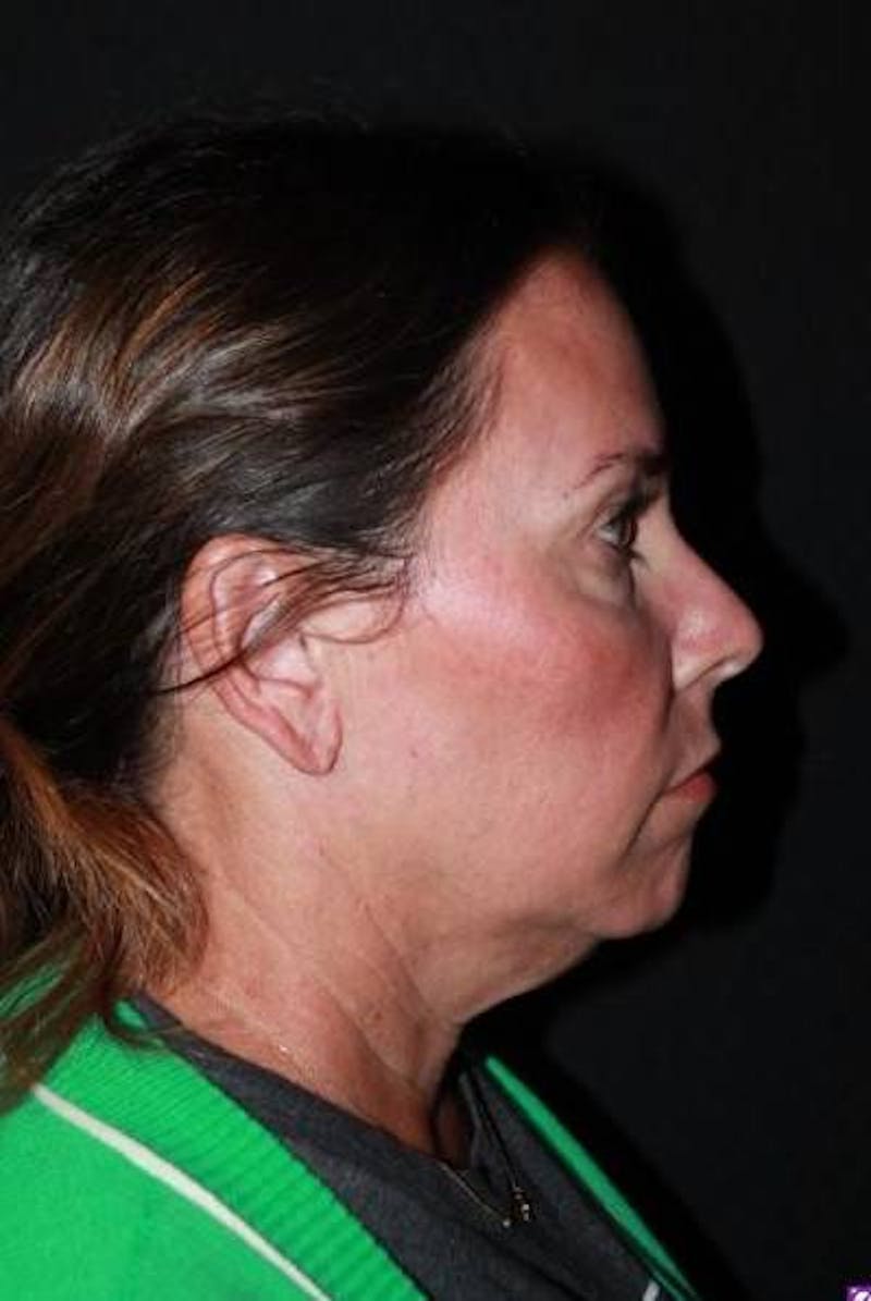 Facelift Before & After Gallery - Patient 391777 - Image 9
