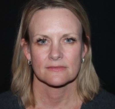 Facelift Before & After Gallery - Patient 189855 - Image 1