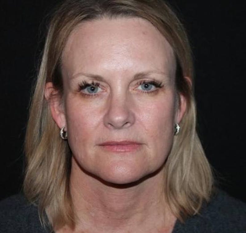 Facelift Before & After Gallery - Patient 189855 - Image 1
