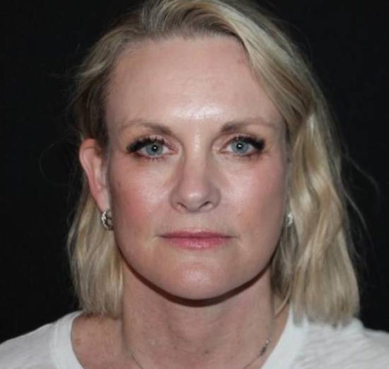 Facelift Before & After Gallery - Patient 189855 - Image 2
