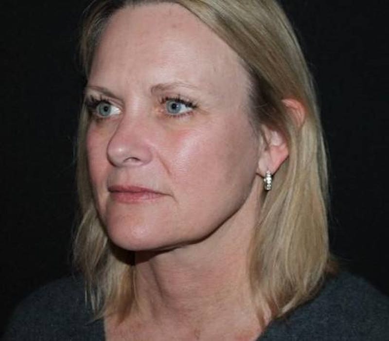 Facelift Before & After Gallery - Patient 189855 - Image 3