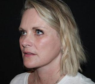 Facelift Before & After Gallery - Patient 189855 - Image 4