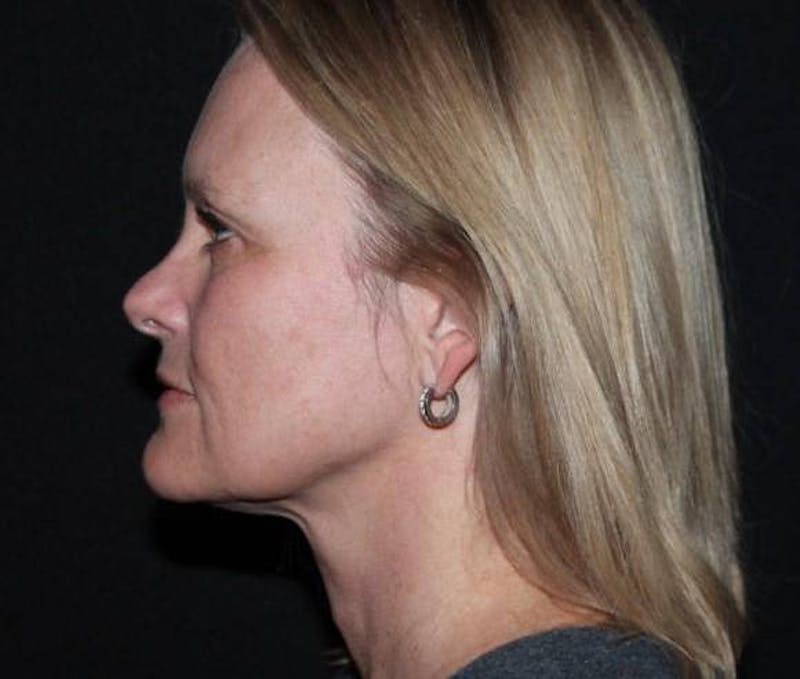 Facelift Before & After Gallery - Patient 189855 - Image 5