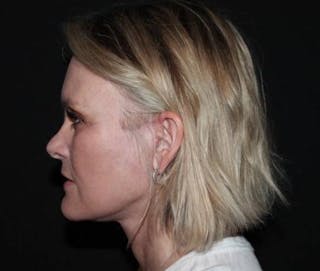 Facelift Before & After Gallery - Patient 189855 - Image 6