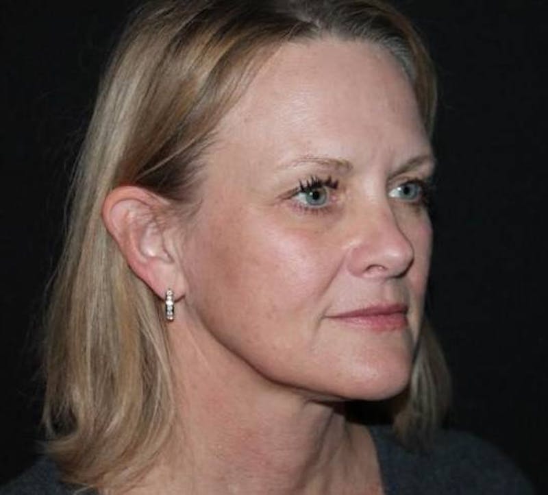 Facelift Before & After Gallery - Patient 189855 - Image 7