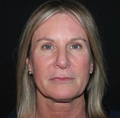 Facelift Before & After Gallery - Patient 508185 - Image 1