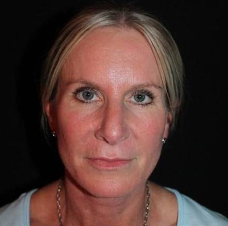 Facelift Before & After Gallery - Patient 508185 - Image 2
