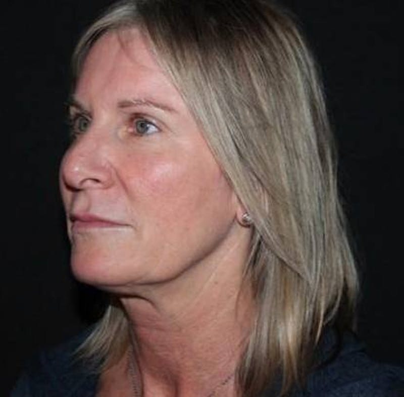 Facelift Before & After Gallery - Patient 508185 - Image 3