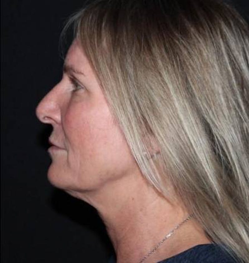 Facelift Before & After Gallery - Patient 508185 - Image 5