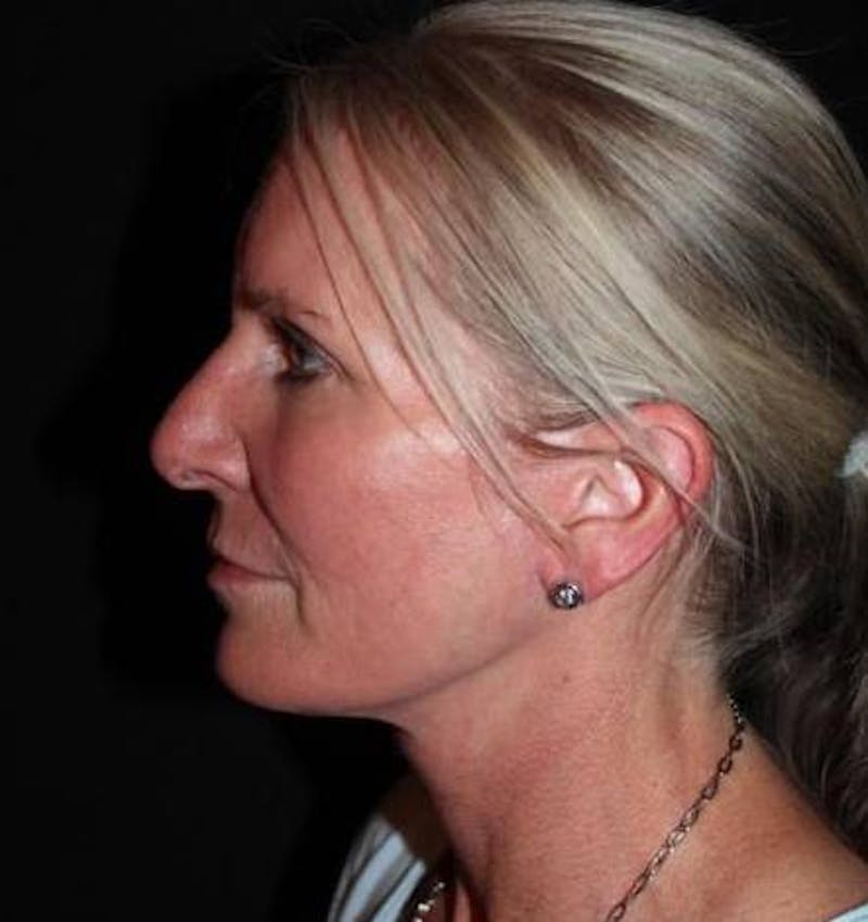 Facelift Before & After Gallery - Patient 508185 - Image 6