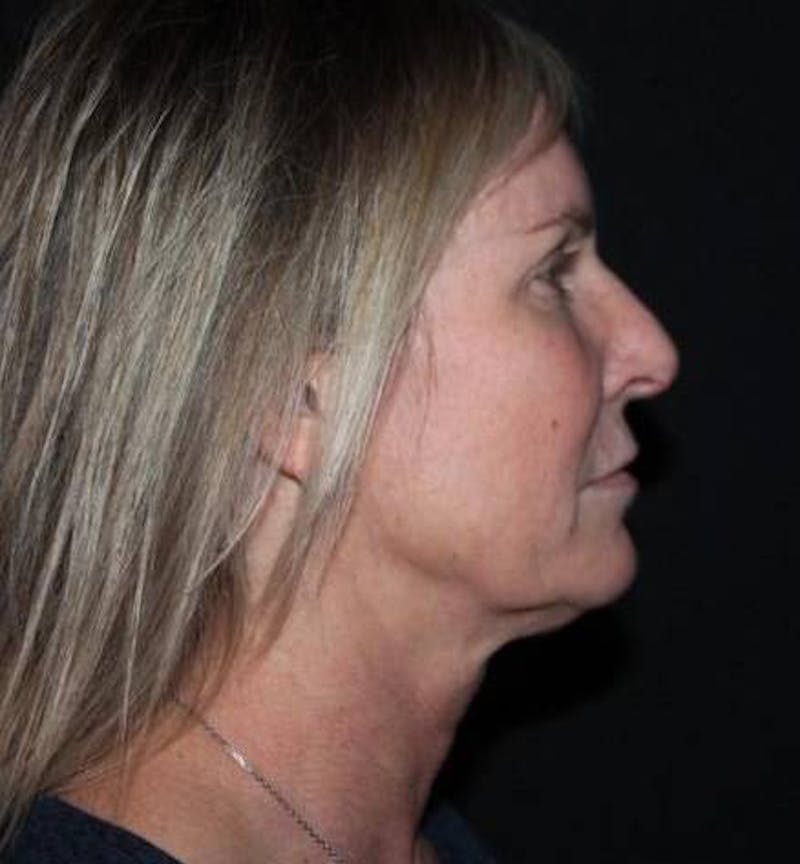 Facelift Before & After Gallery - Patient 508185 - Image 9