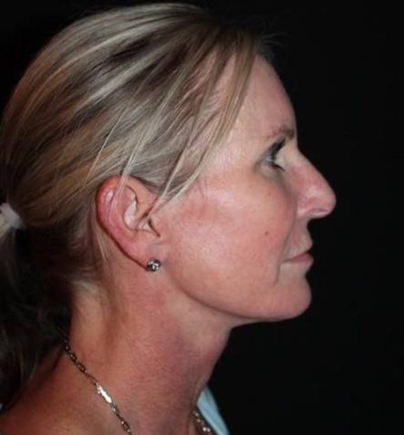 Facelift Before & After Gallery - Patient 508185 - Image 10