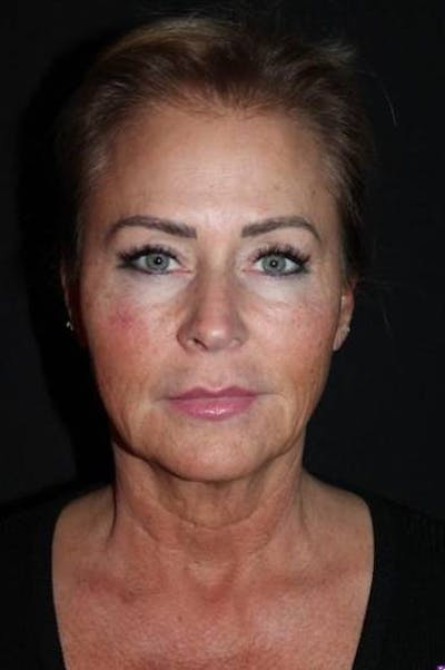 Facelift Before & After Gallery - Patient 104007 - Image 1